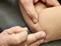 Dry Needling