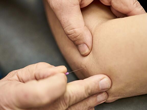Dry Needling
